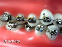 Bracket Description