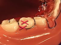 C Clasp - Ball Clasp Combo