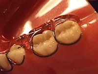 C-Clasp Description
