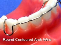 Contoured Labial Bow Description