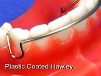 Coated Labial Bow Description