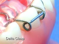 Delta Clasp Description