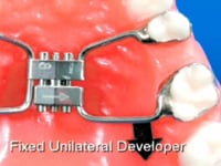 Fixed Distal Expansion Screw Description