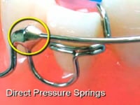 Labial Bow Rotation Springs Description