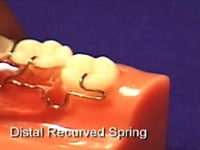 Lingual Uprighting Molar Spring Description