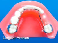 Lower Lindual Holding Arch Description