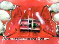Memory Screw Description