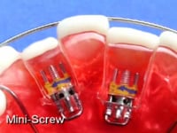 Mini Expansion Screw Description