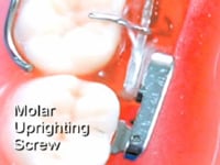 Molar Uprighting Screw Description