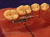 Molar Uprighting Screw