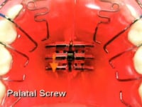 Palatal Exspansion Screw Description