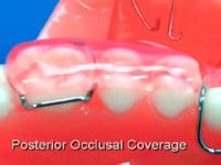 Posterior Acrylic Coverage Description