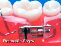Pre-Opened Retraction Screw Description