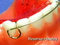 Recurve Labial Bow Description