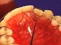 Recurved Finger Spring Adjustments