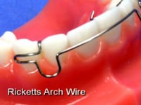 Ricketts Labial Bow Description