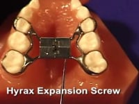 RPE Expansion Screw Description
