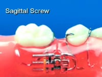 Saggital Expansion Screw Description