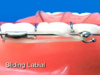 Sliding Labial Retraction Bow Description