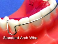 Standard Labial Bow Description