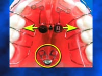 Swing Lock Expansion Screw Description