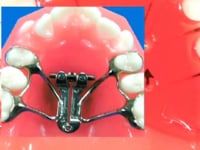 Whipla Expansion Screw Description