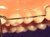 Wrap Around Labial Bow Description
