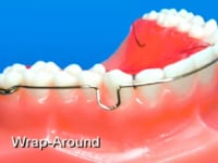 Wrap Around Labial Bow Discription