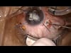 Mature Cataract and Sympathetic Ophthalmia