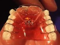 Anterior Sagittal Expansion Screw Adjustment