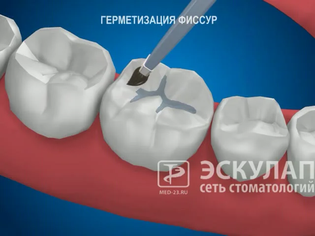 Герметизация фиссур у детей. Для чего это делают?