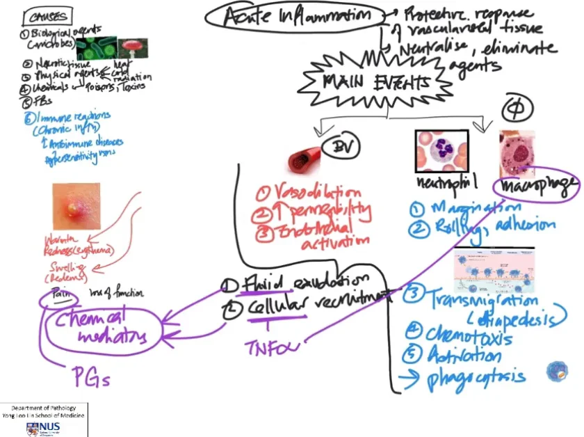 Acute inflammation mindmap on Vimeo