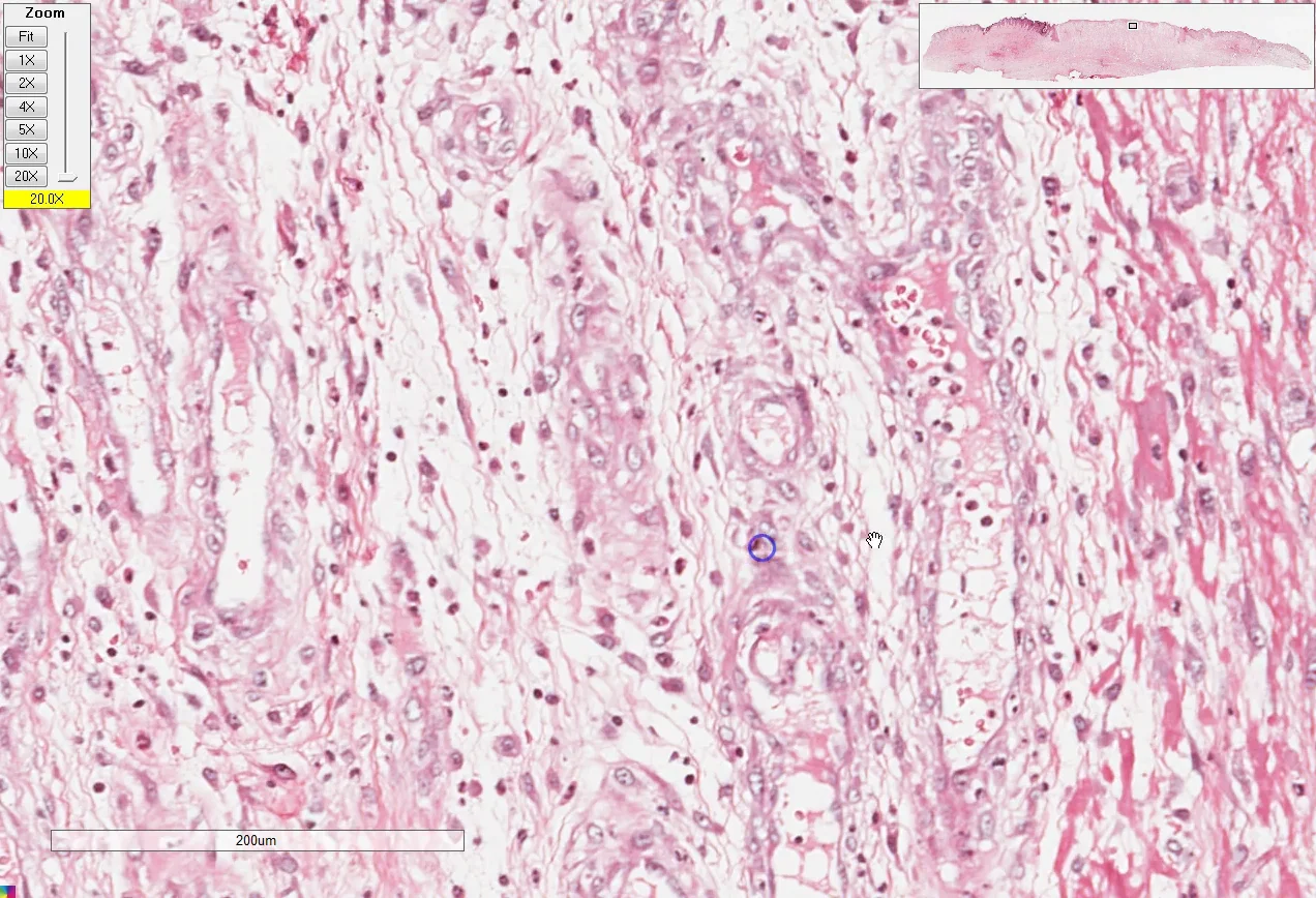 granulation tissue