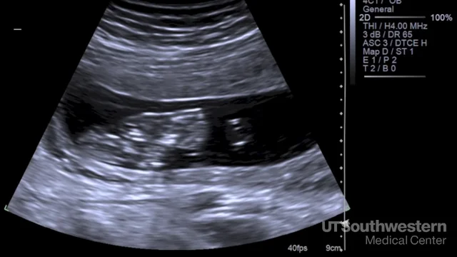 down syndrome baby ultrasound