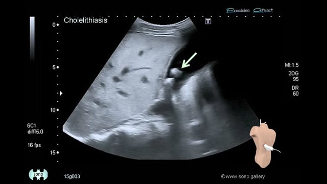 Cholelithiasis