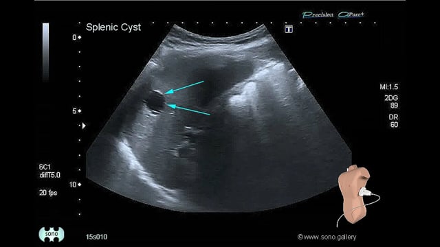 Splenic Cyst