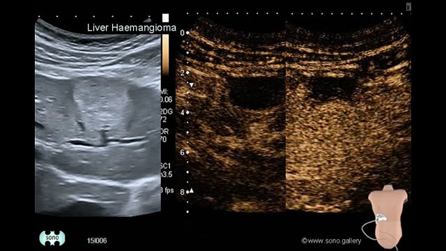 Liver Haemangioma