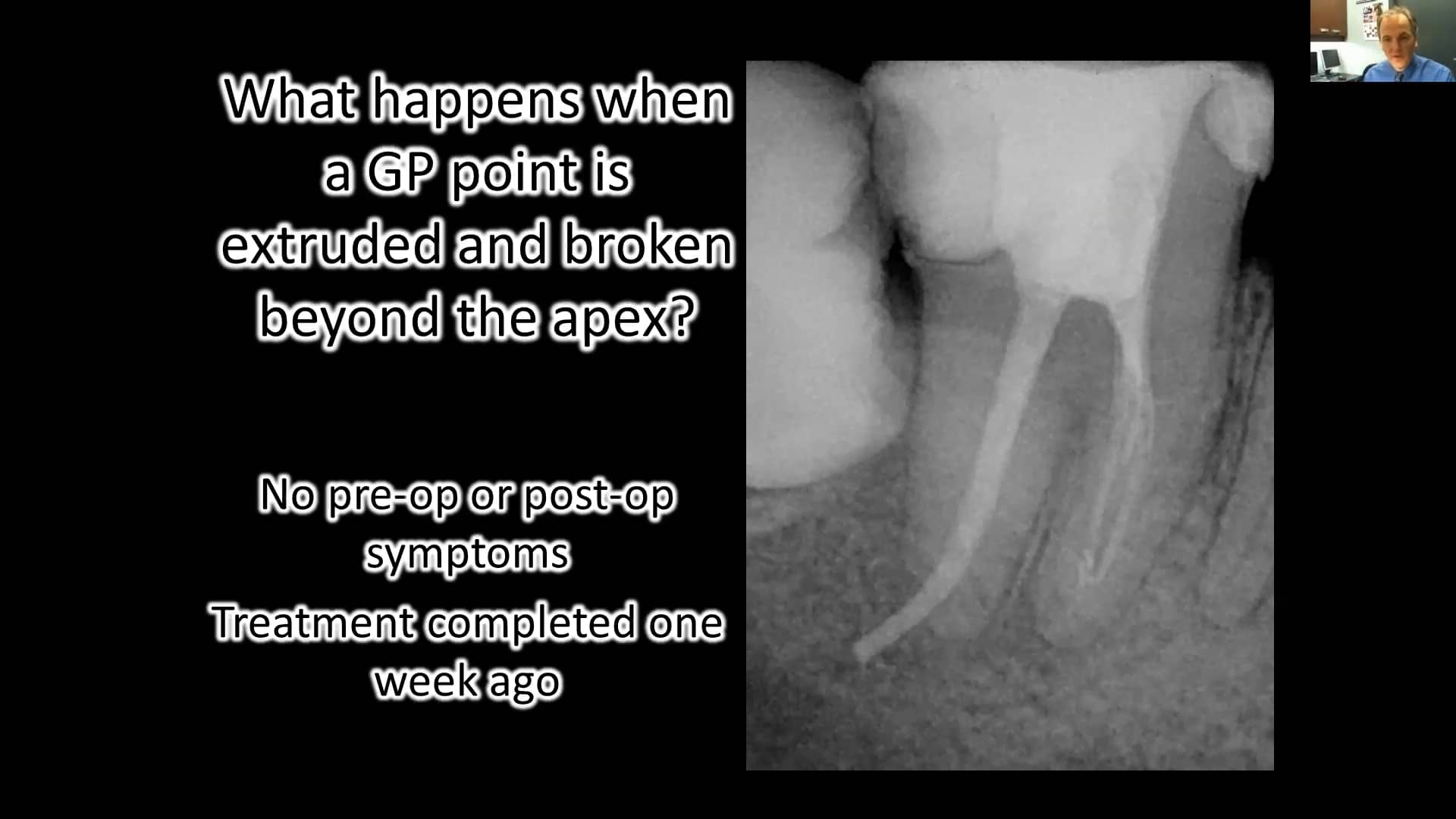 What happens when a gutta percha is extruded and broken beyond the apex