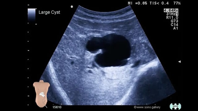 large liver cyst