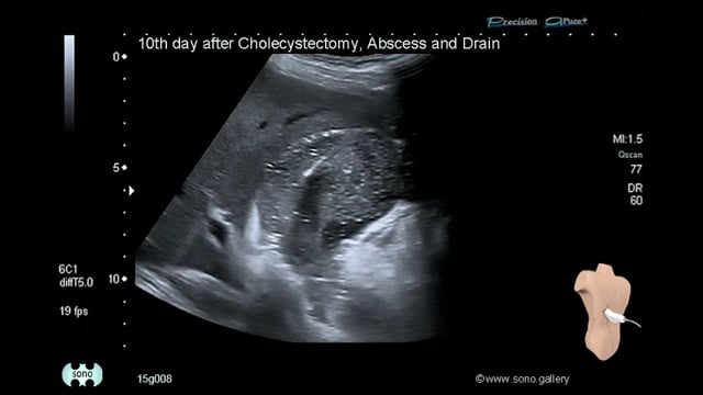 abscess, drainage, cholecystectomy