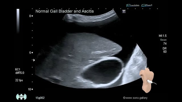 Normal Gall Bladder and Ascites