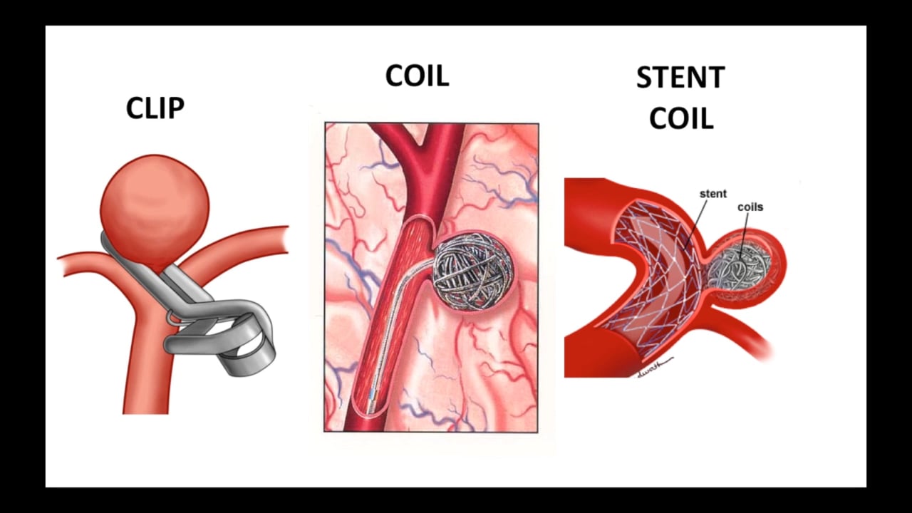 Brain Attack - Unruptured Aneurysms on Vimeo
