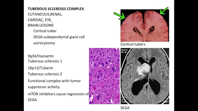 Brain Tumors