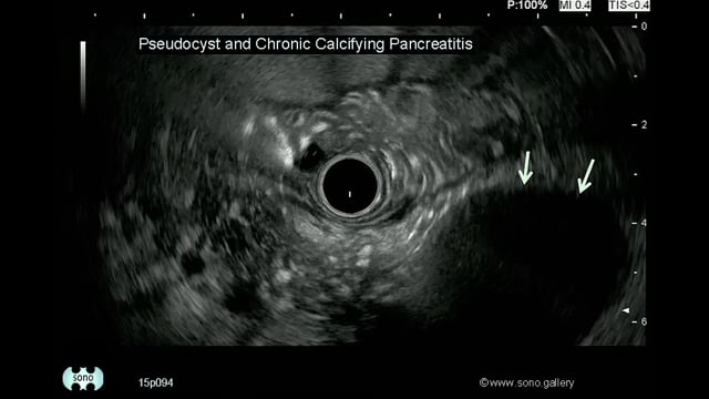 pancreatic pseudocyst
