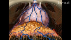 prostatectomie radicale avis