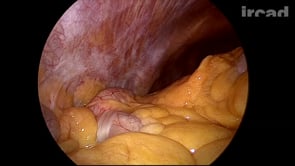 Colectomie Droite Laparoscopique Entierement Mediale Pour Cancer Du Colon Ascendant Websurg The Online University Of Ircad