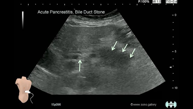 Acute Pancreatitis, Bile Duct Stone