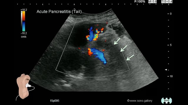 Acute Pancreatitis (Tail)