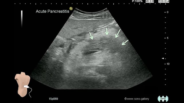 Acute Pancreatitis
