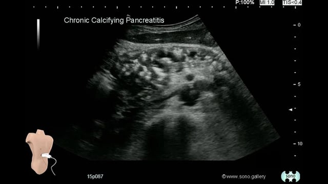 chronic pancreatitis